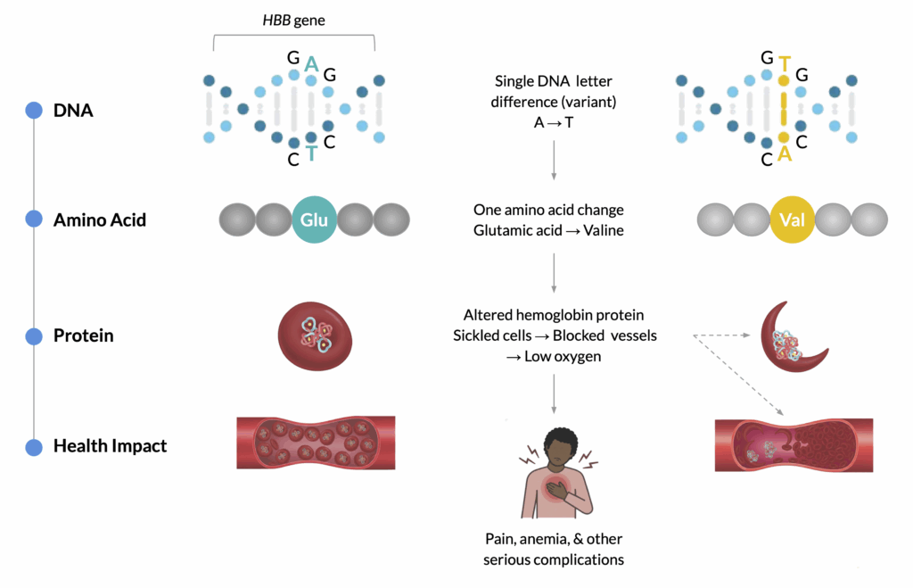 How a single genetic variant causes sickle cell anemia. At the DNA level, there is a single DNA letter difference (variant) in the HBB gene: an A is replaced by a T. At the amino acid level, this causes one amino acid change, from glutamic acid (Glu) to valine (Val). At the protein level, this results in an altered hemoglobin protein, which can cause red blood cells to become sickled (crescent-shaped). These sickled cells can block blood vessels and reduce oxygen levels. This leads to the health impacts seen in people with sickle cell anemia, including pain, anemia, and other serious complications.